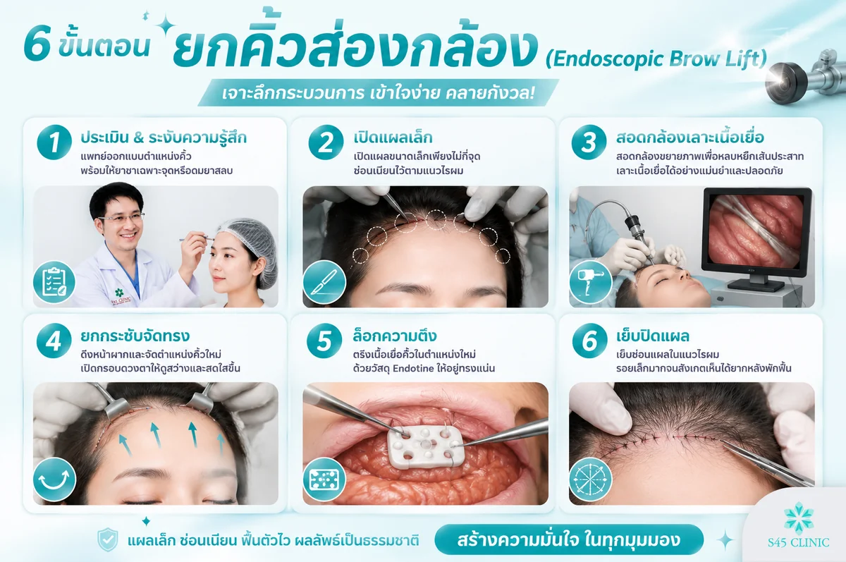 ขั้นตอนการทำ Endoscopic Brow Lift ตั้งแต่เปิดแผลถึงตรึงตำแหน่งคิ้ว