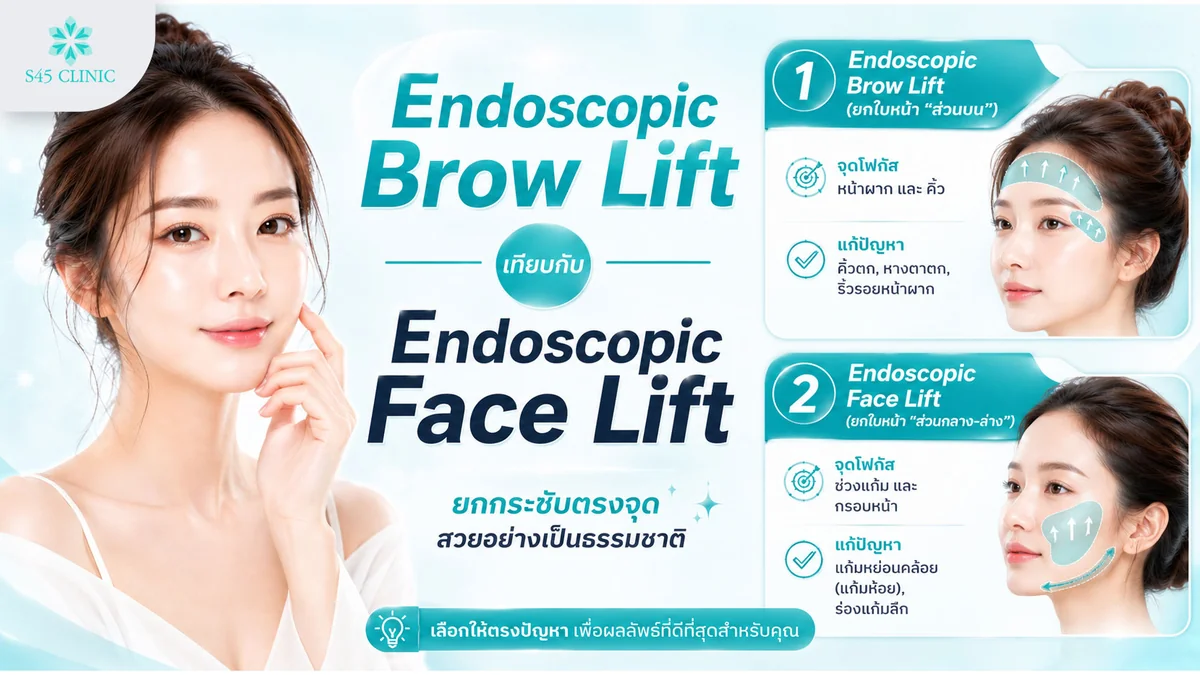 เปรียบเทียบ Endoscopic Brow Lift กับ Endoscopic Face Lift แก้คนละบริเวณ