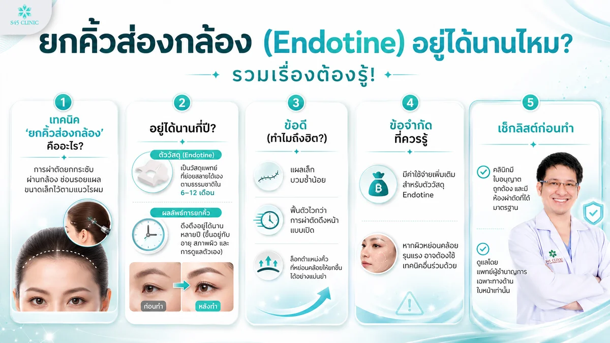 ยกคิ้วส่องกล้อง อยู่ได้นานไหม เอนโดไทน์อยู่กี่ปี รวมเรื่องต้องรู้