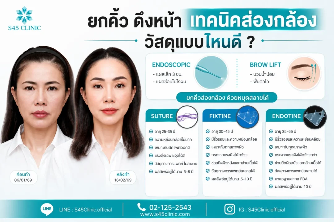 endotine brow lift how it works1