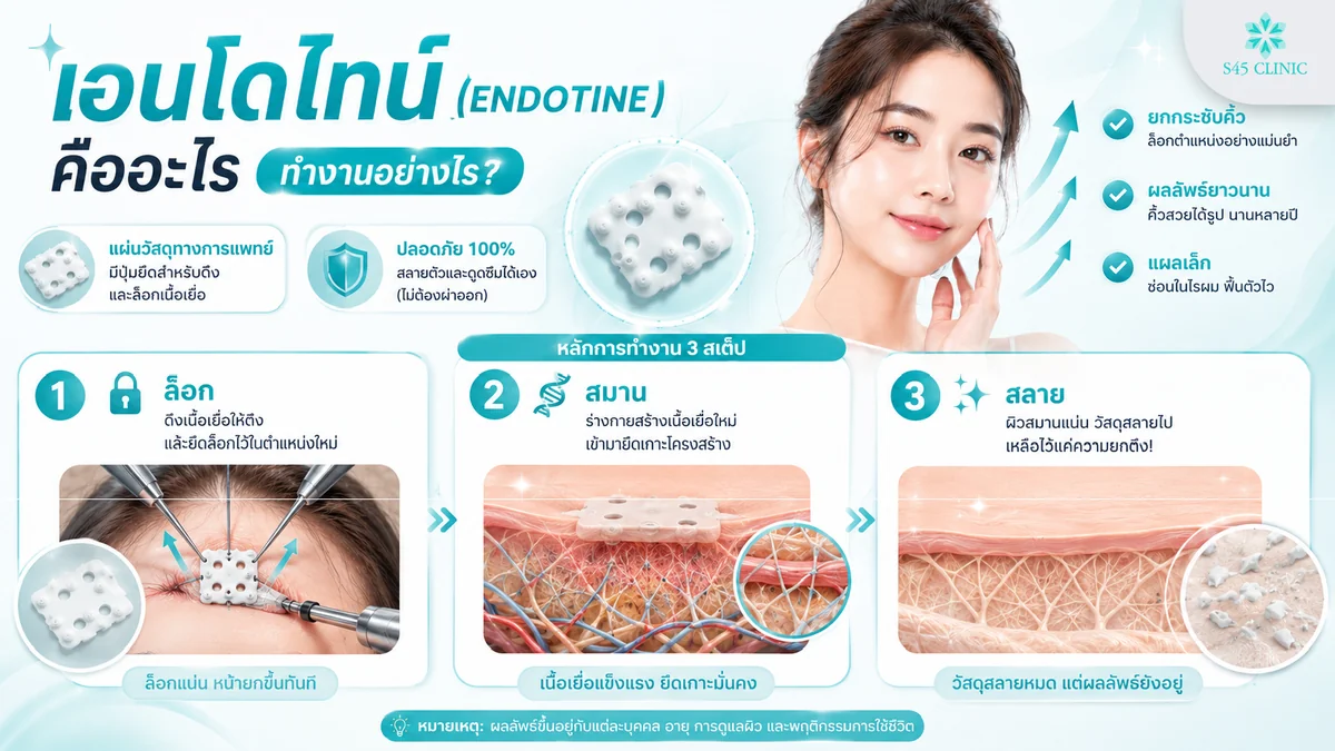 เอนโดไทน์ คือวัสดุยึดตรึงเนื้อเยื่อชนิดย่อยสลายได้ที่ใช้ในการยกคิ้ว