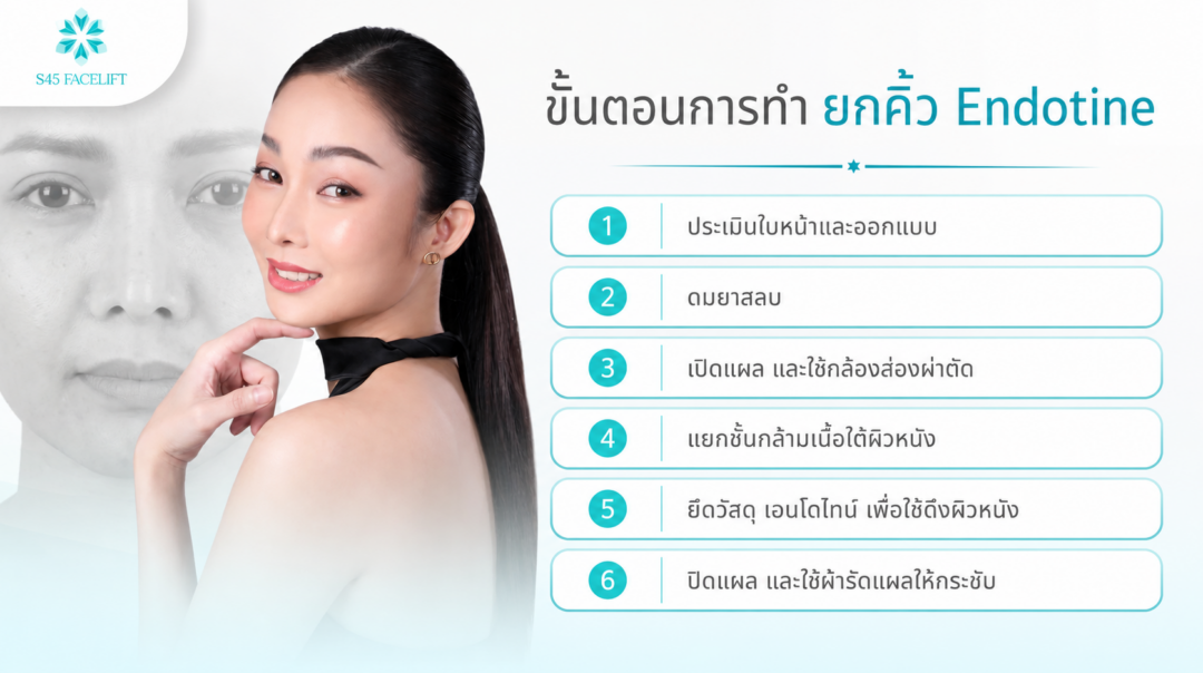 endotine brow lift procedure steps