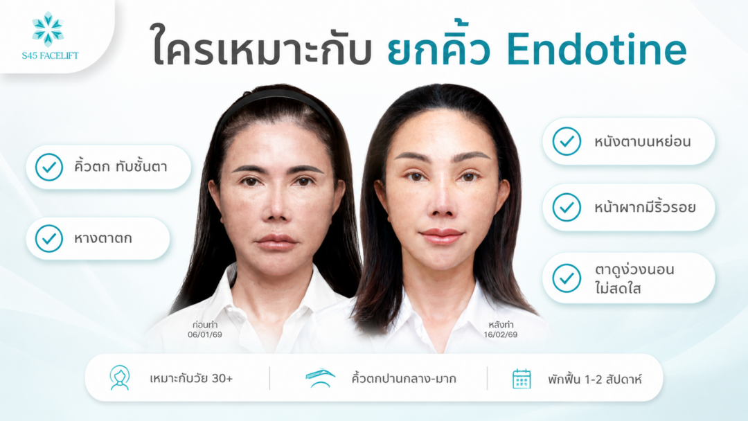 endotine brow lift who suits