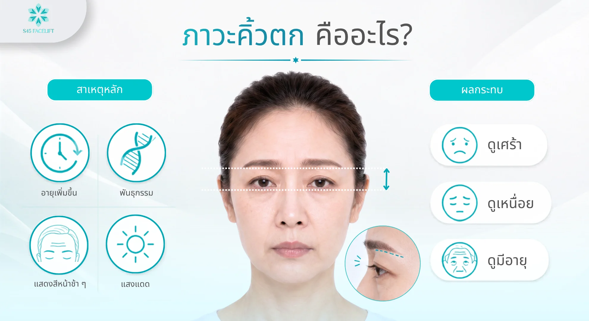 ภาวะคิ้วตก (Brow Ptosis) คืออะไร สาเหตุหลักและผลกระทบต่อใบหน้า