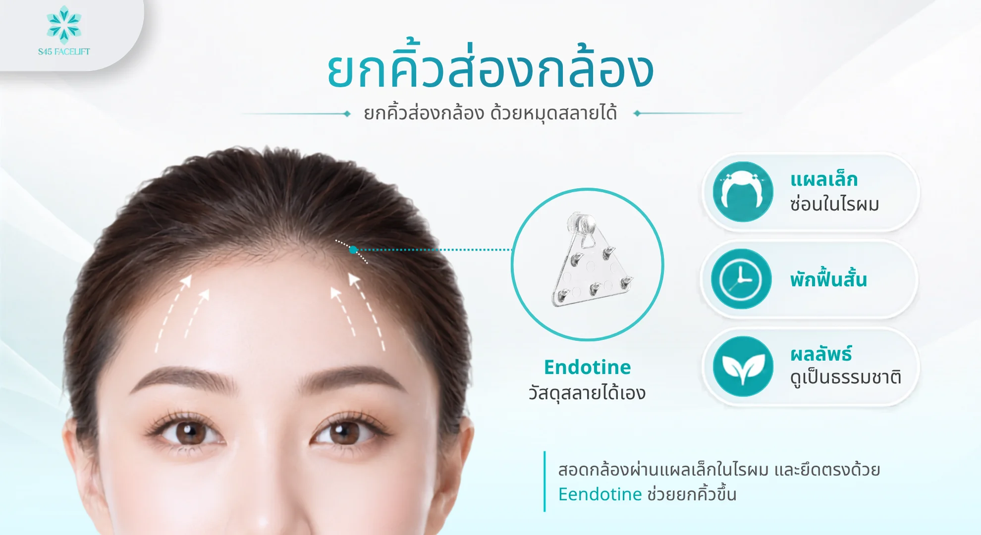 ยกคิ้วส่องกล้อง Endoscopic Brow Lift ด้วยหมุด Endotine สลายได้เอง แผลเล็กซ่อนในไรผม