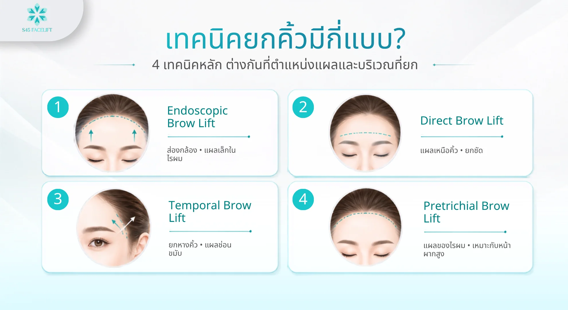เทคนิคยกคิ้ว 4 แบบ Endoscopic Direct Temporal และ Pretrichial Brow Lift