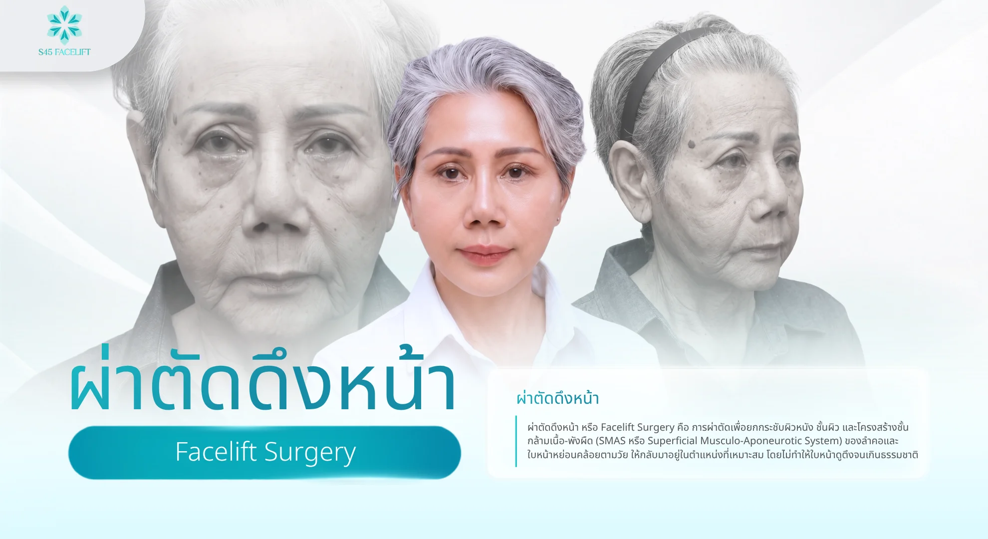 ผ่าตัดดึงหน้า คืออะไร 4 เทคนิค ข้อดี และวิธีเลือกคลินิก