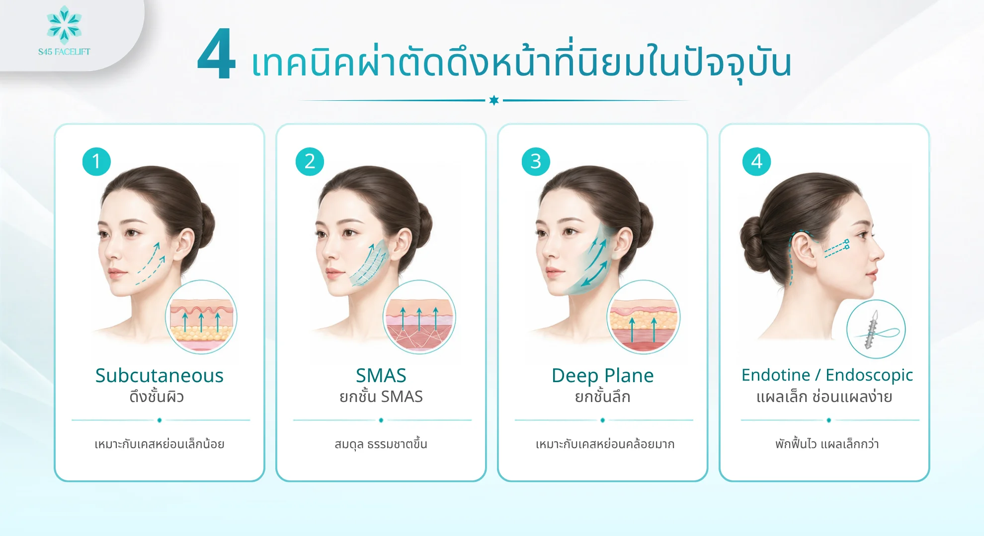 4 เทคนิคผ่าตัดดึงหน้า Subcutaneous SMAS Deep Plane และ Endotine เปรียบเทียบ