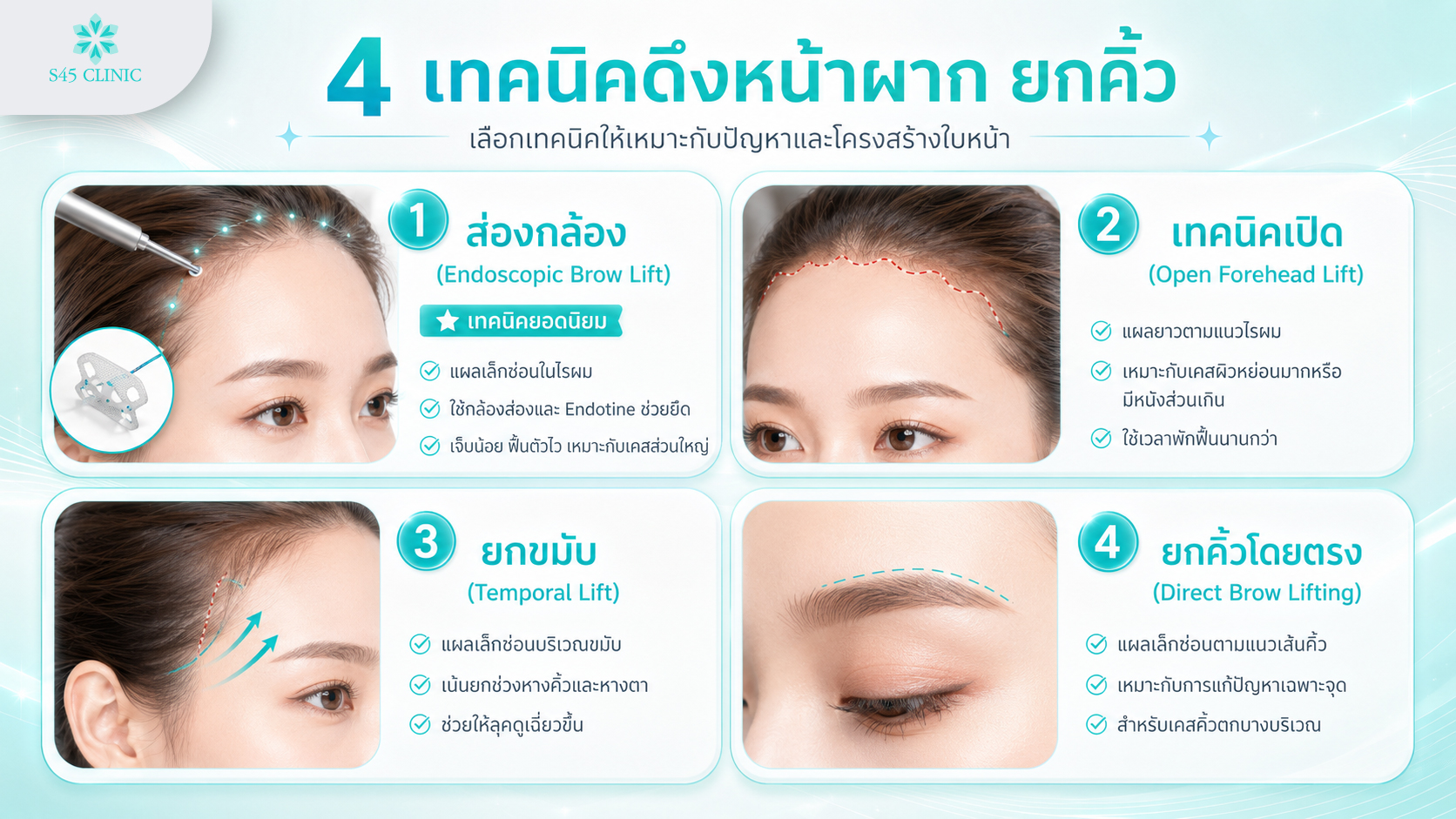 เปรียบเทียบเทคนิคดึงหน้าผากยกคิ้ว Endoscopic Forehead Lift Open Lift Temporal Lift