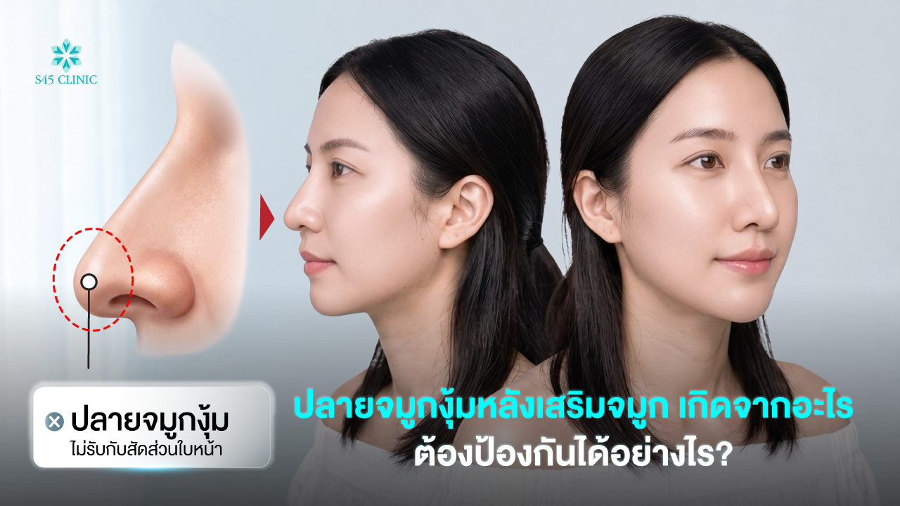 httpss45clinic comdroopy nose tip after rhinoplasty s45clinic