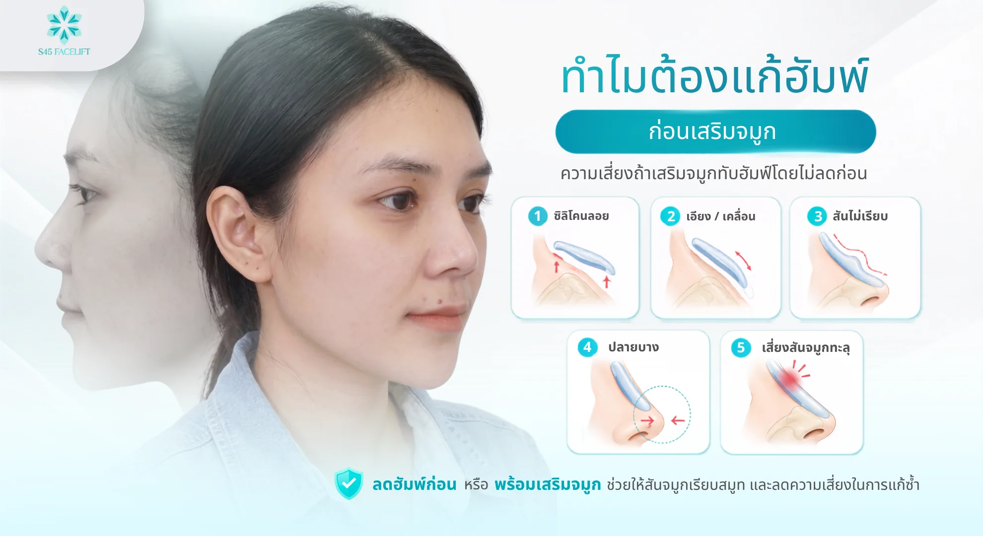 ฮัมพ์จมูก ก่อนเสริมจมูก