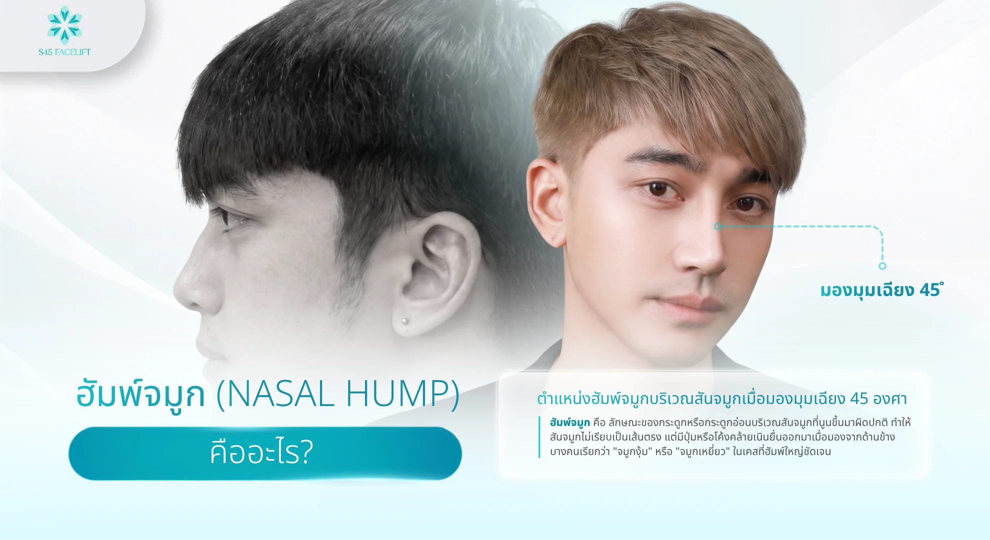 ฮัมพ์จมูก คืออะไร