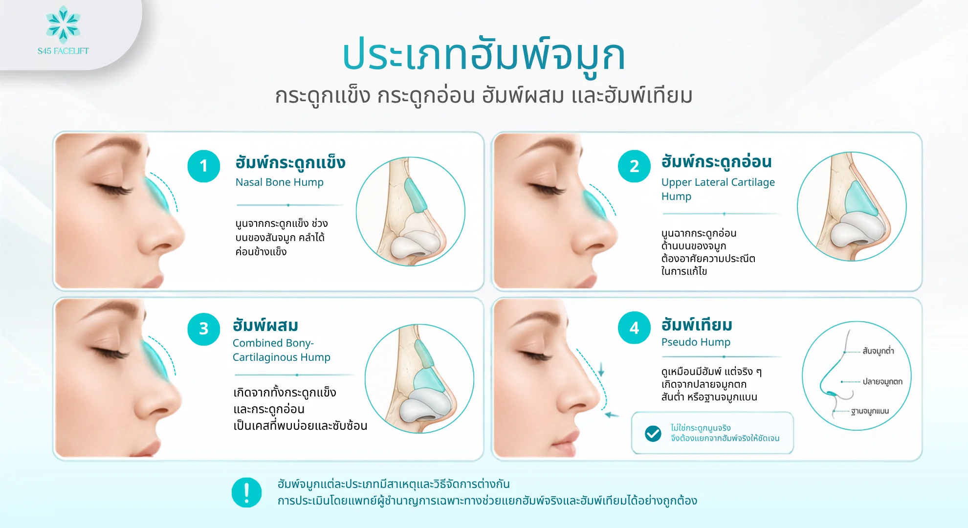 ฮัมพ์จมูก ประเภท