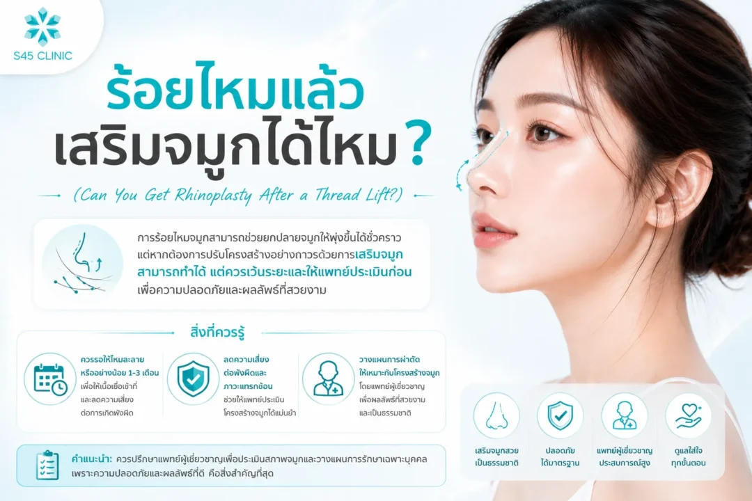 nose augmentation after a thread lift 11zon