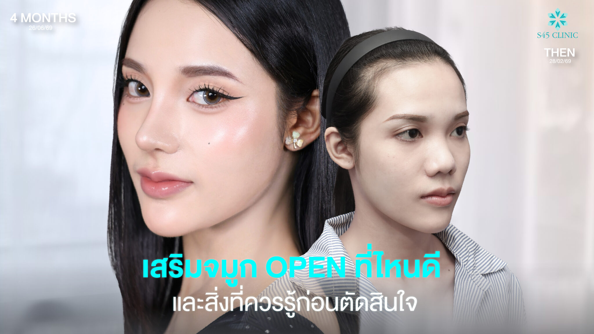 open rhinoplasty guide s45 clinic