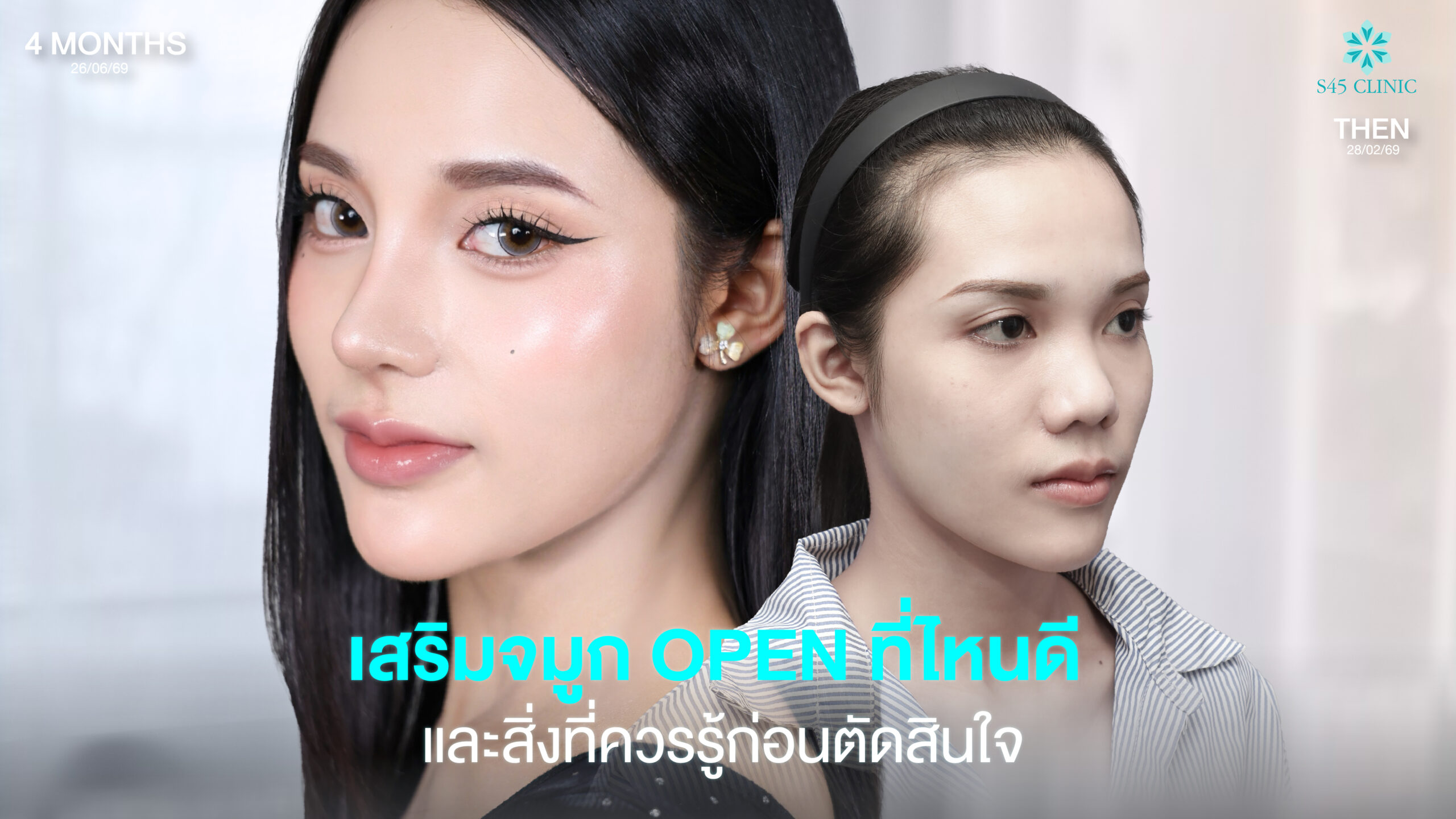 open rhinoplasty guide s45 clinic