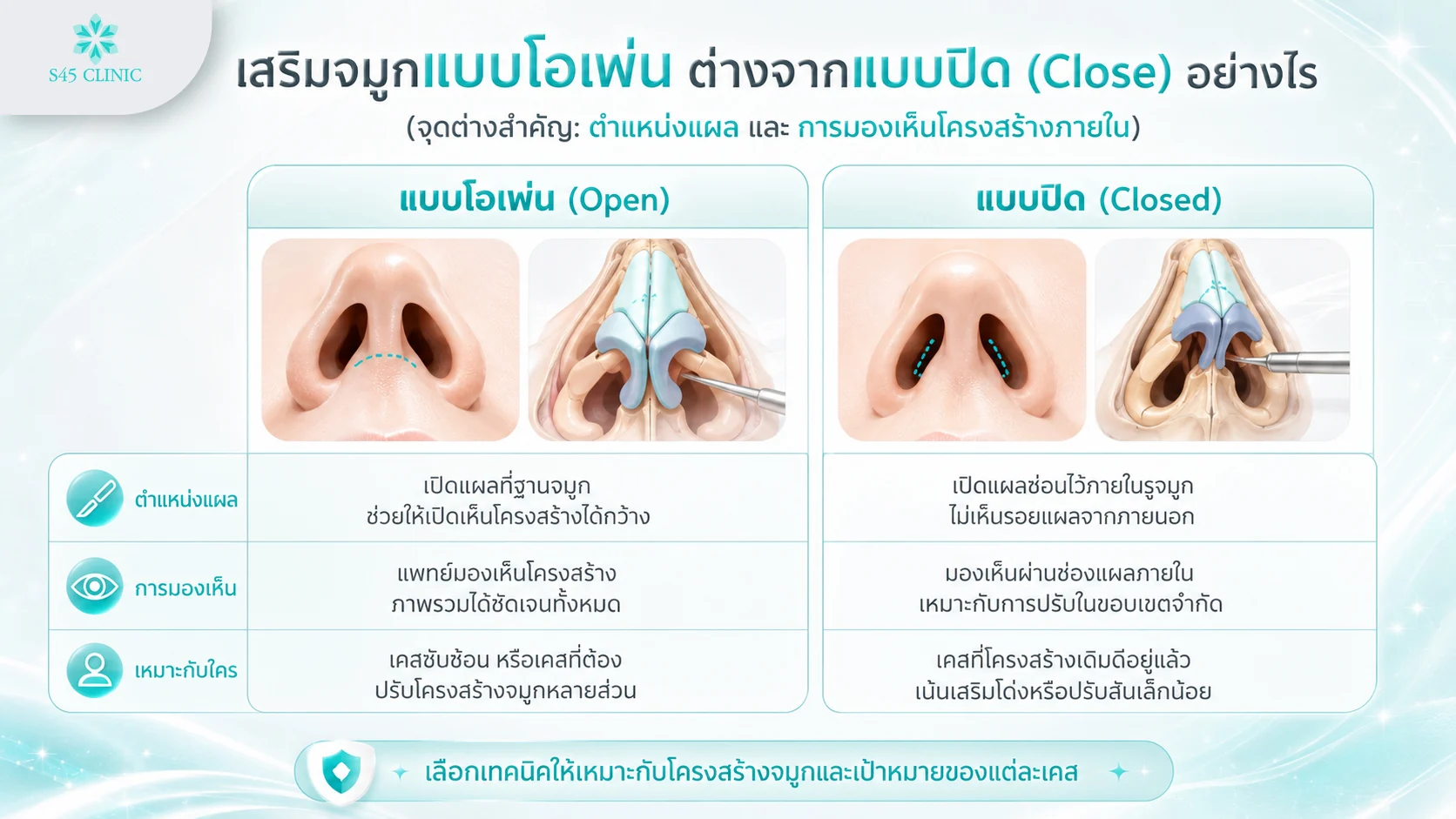 เปรียบเทียบเสริมจมูกแบบโอเพ่น (Open) กับแบบปิด (Closed) ตำแหน่งแผลและการมองเห็นโครงสร้าง