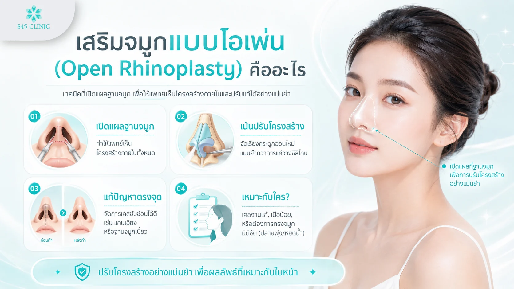 เสริมจมูกแบบโอเพ่น คืออะไร เปิดแผลฐานจมูกให้แพทย์เห็นโครงสร้างภายในและปรับแก้ได้แม่นยำ