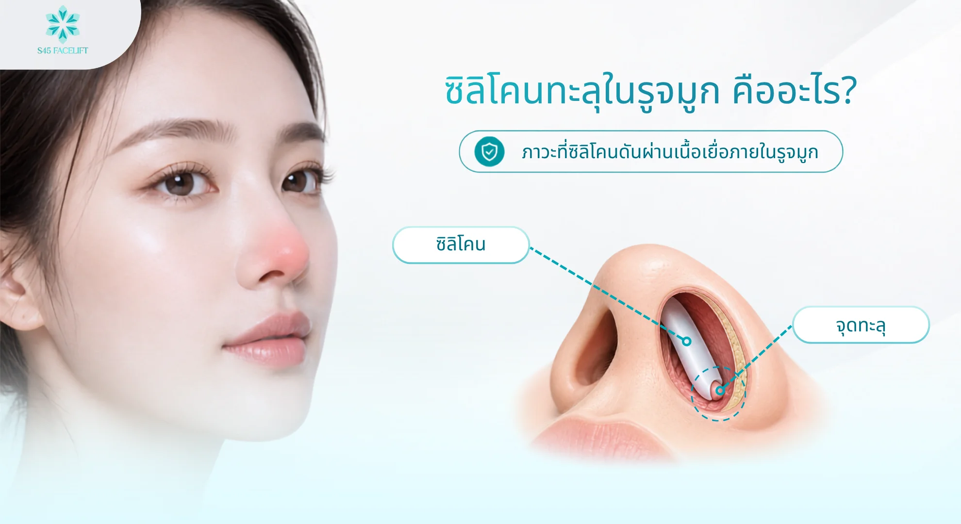 ซิลิโคนทะลุในรูจมูก คืออะไร