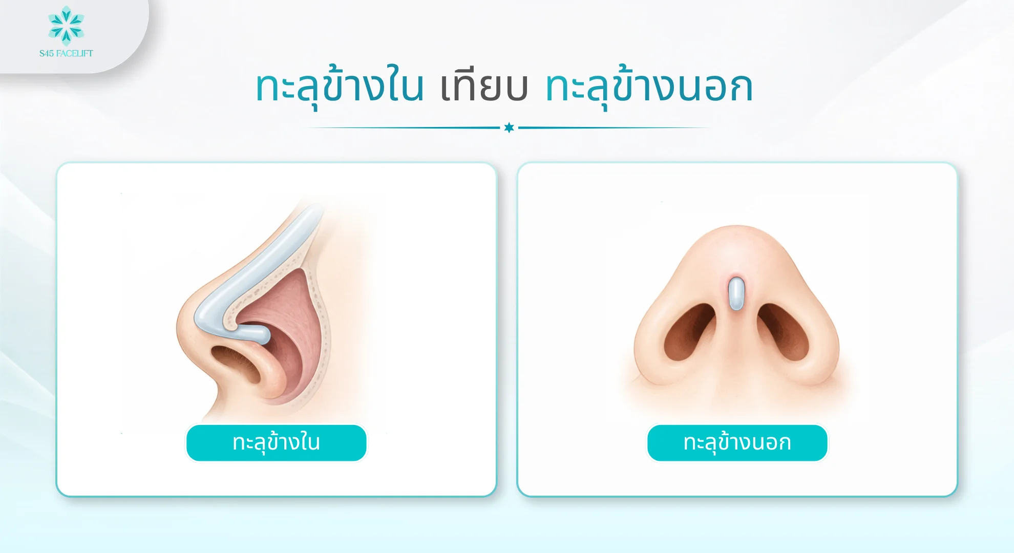 ซิลิโคนทะลุในรูจมูก ทะลุด้านใน vs ด้านนอก
