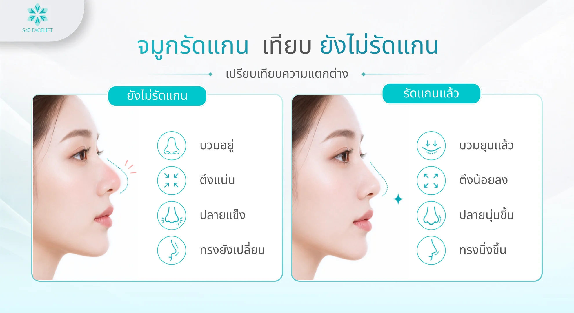 เปรียบเทียบจมูกรัดแกนแล้วกับยังไม่รัดแกน อาการบวม ความตึง ปลายและทรงจมูก