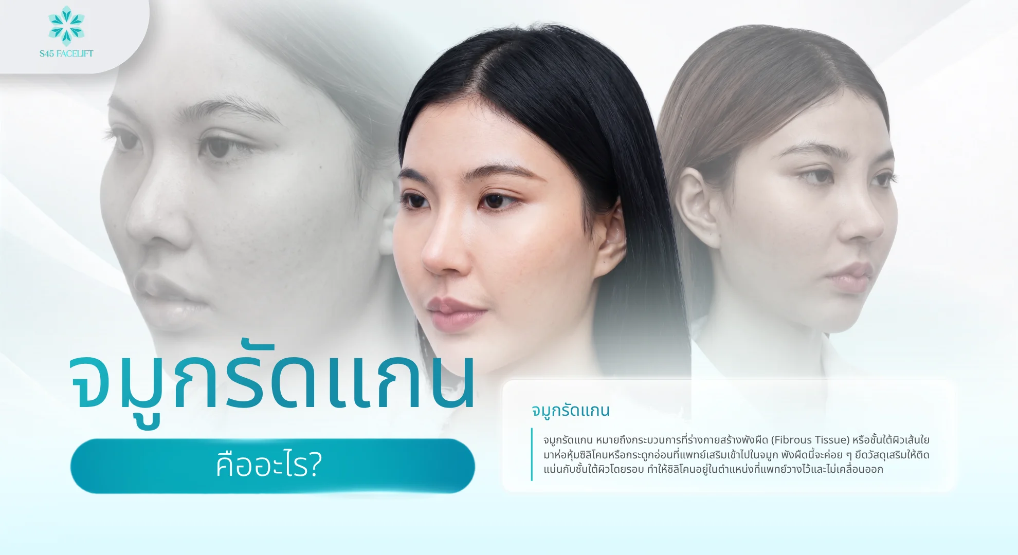 จมูกรัดแกน คืออะไร กี่เดือนเข้าที่ สัญญาณว่ารัดแกนแล้วและวิธีดูแลให้สวย