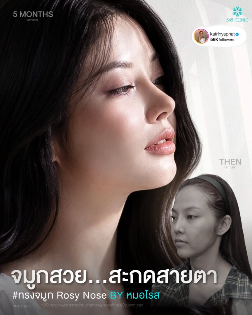 จมูกทรงหยดน้ำ (Teardrop Shape)