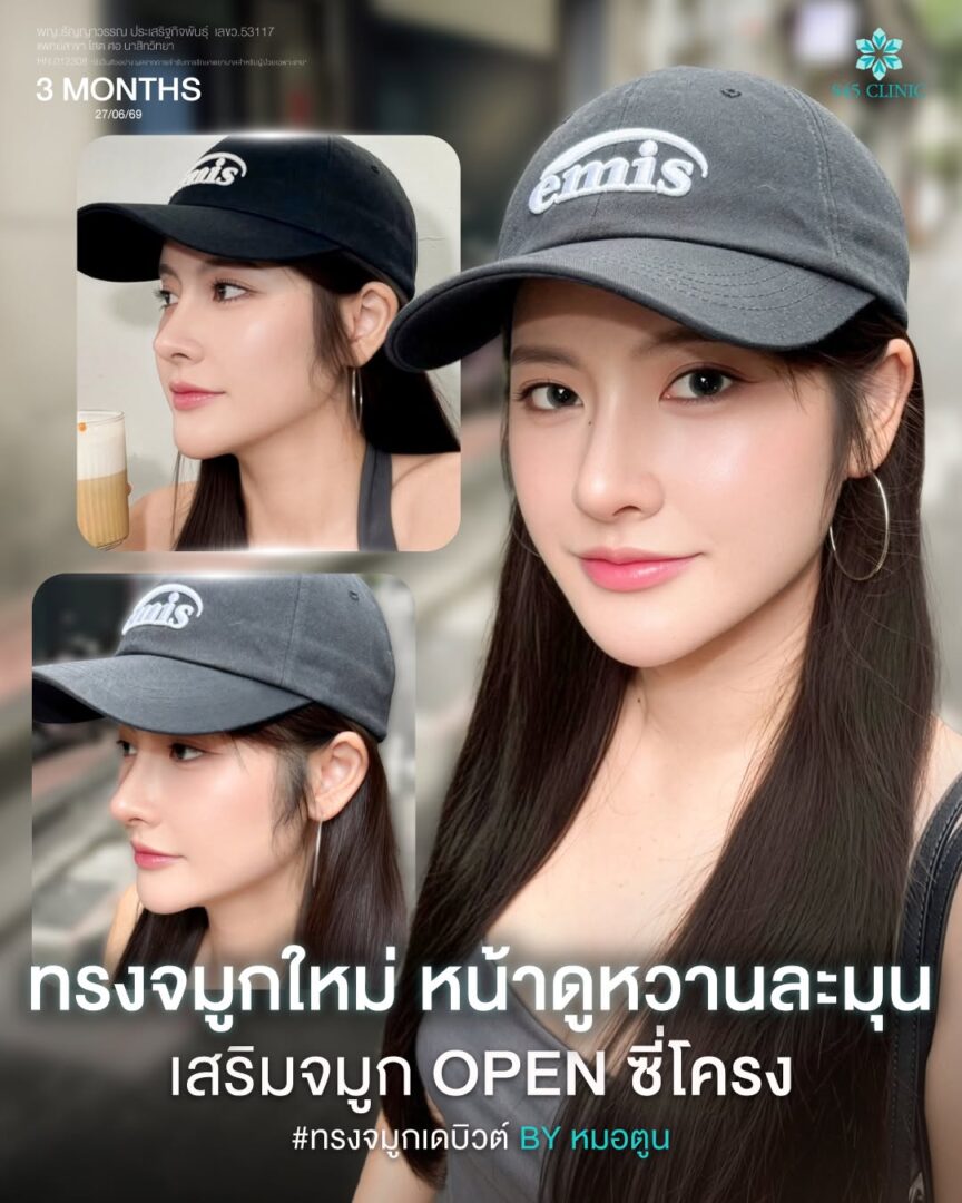 ทรงจมูกธรรมชาติ