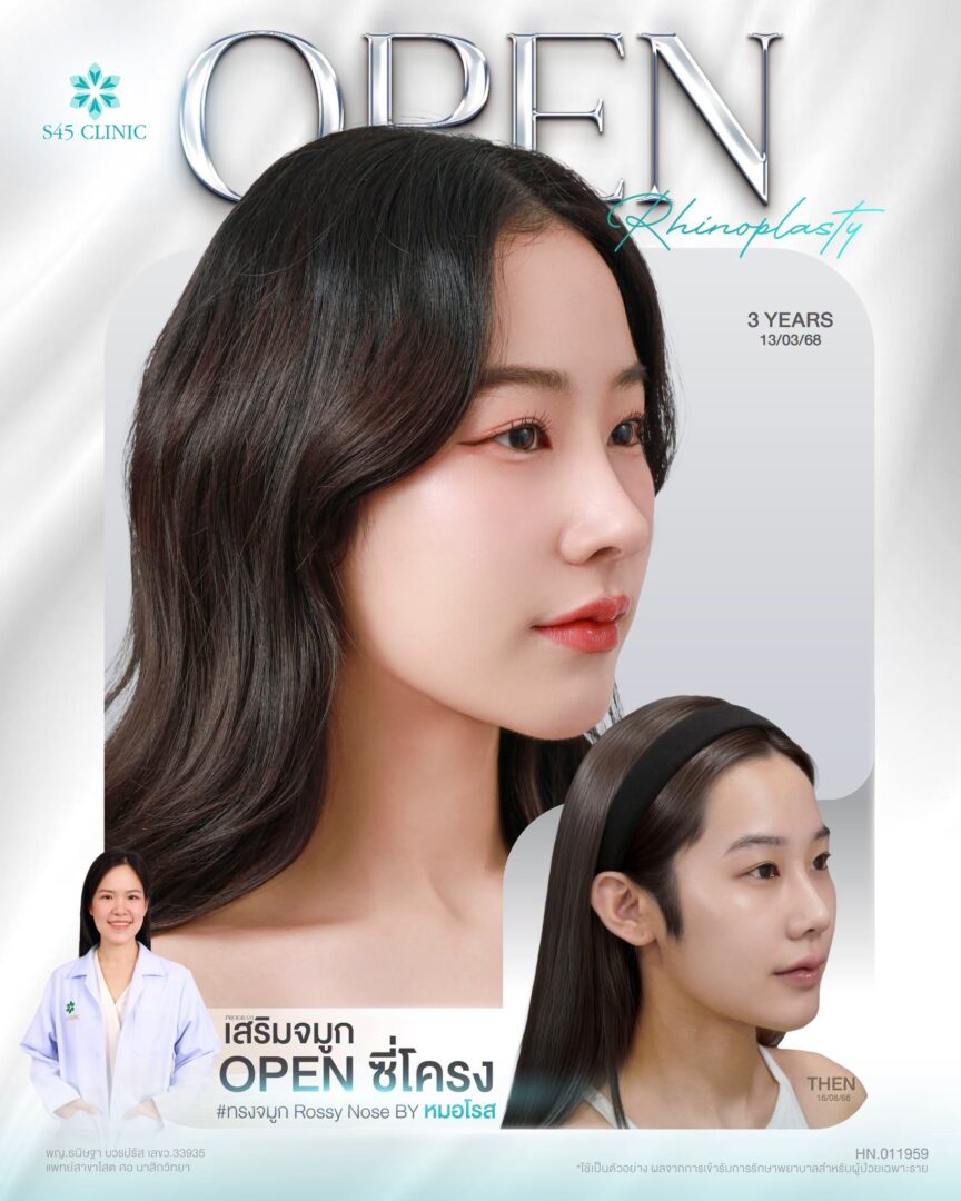 ทรงจมูกสโลปปลายพุ่ง