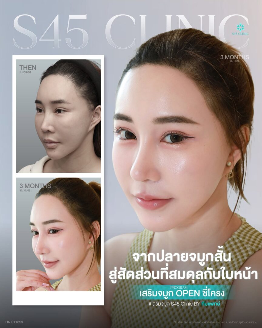 ทรงจมูกสโลปปลายพุ่ง S45 Clinic