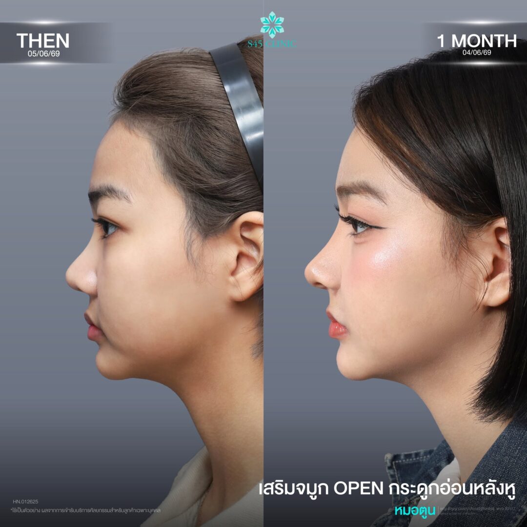 ทรงจมูกใช้กระดูกอ่อนหลังหู