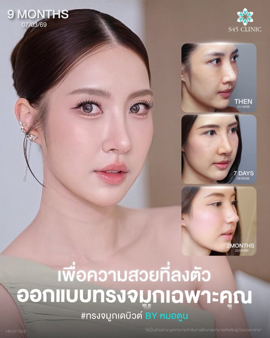 ทรงสโลปปลายพุ่ง S45 Clinic
