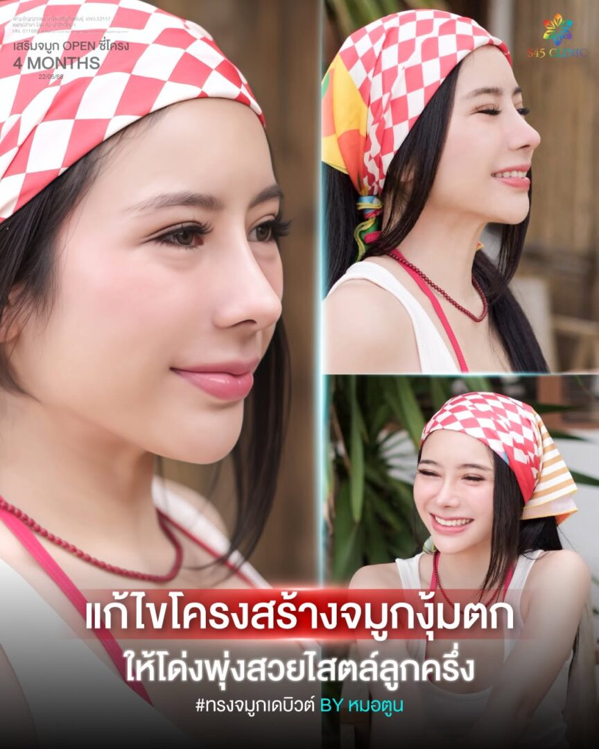 ปลายจมูกงุ้ม