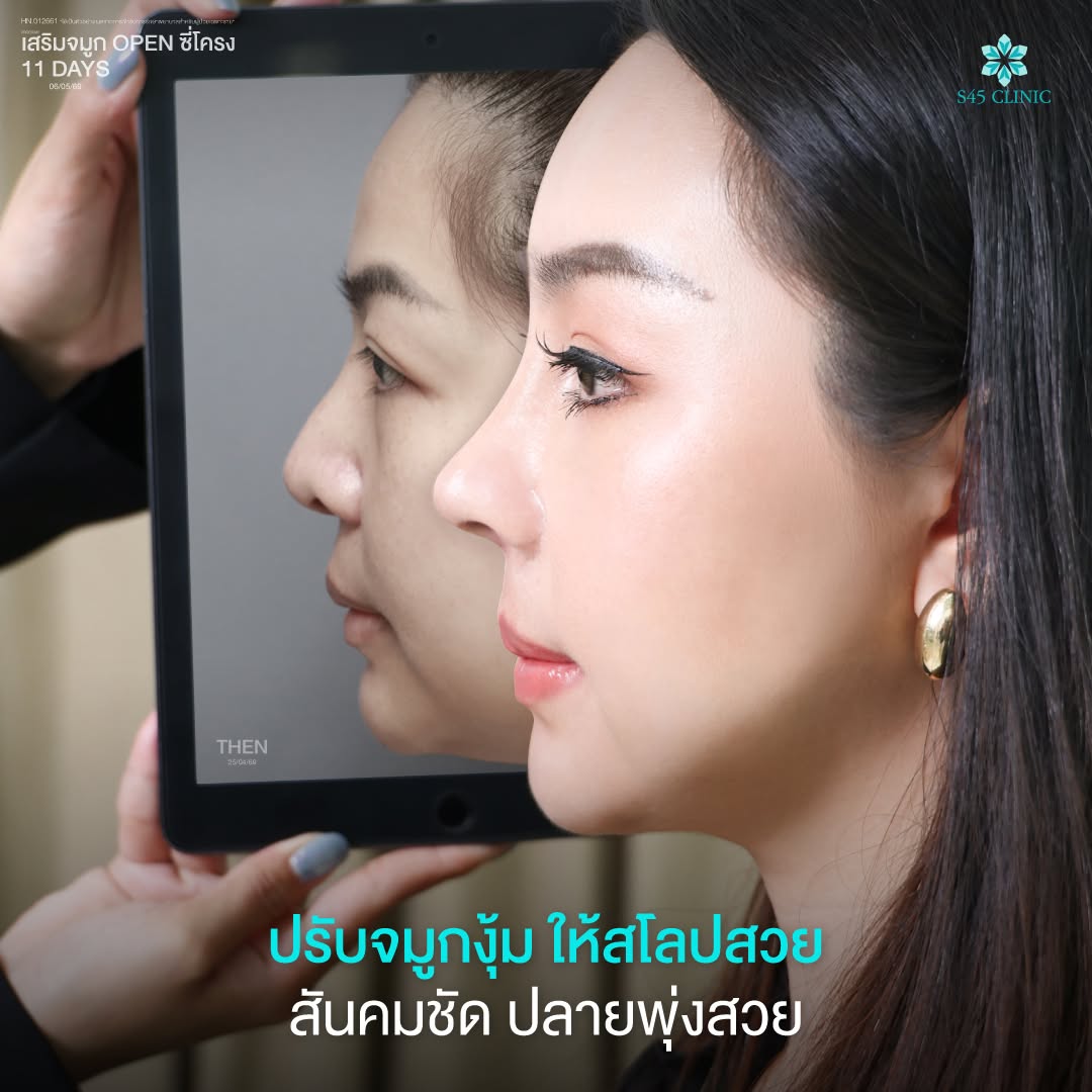 ปลายจมูกงุ้มตก