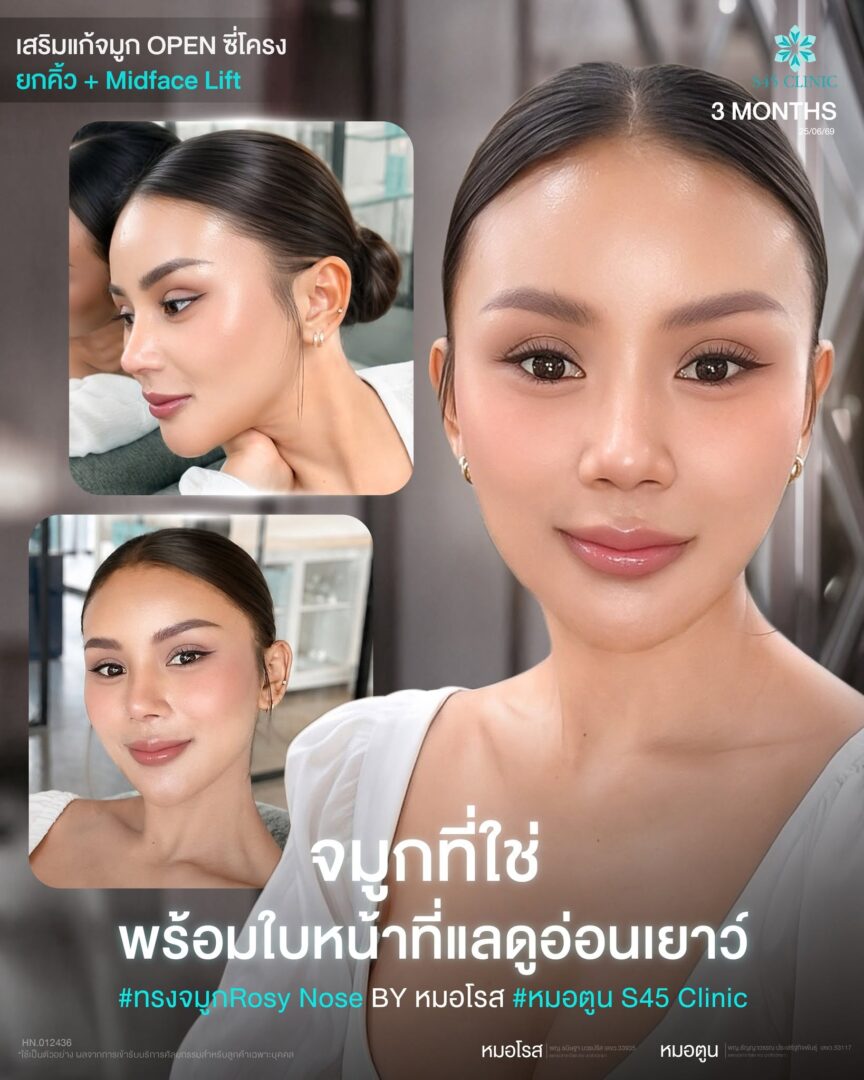 รีวิวเสริมจมูก S45 Clinic