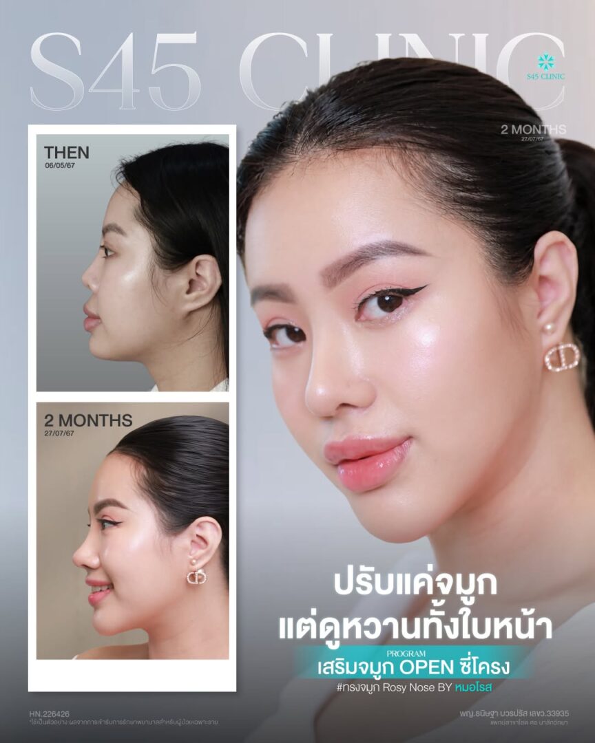 รีวิวเสริมจมูก ที่ S45 Clinic