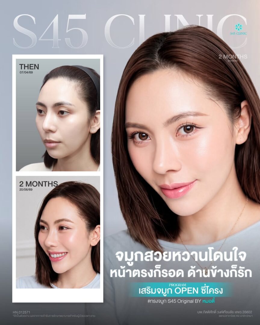 รีวิวเสริมจมูก โอเพ่น