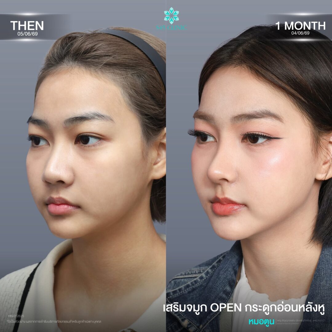 เสริมจมูก open กระดูกอ่อนหลังหู