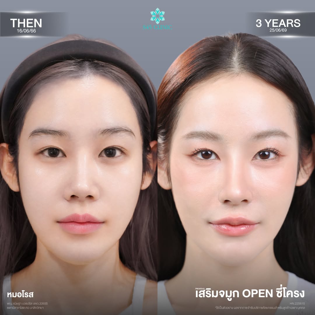 เสริมจมูก open ซี่โครง S45 Clinic
