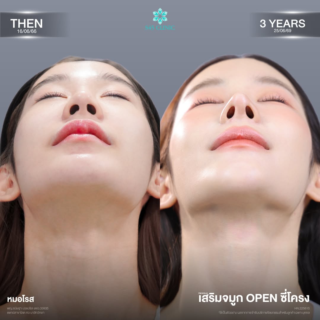 เสริมจมูก ซี่โครง S45 Clinic