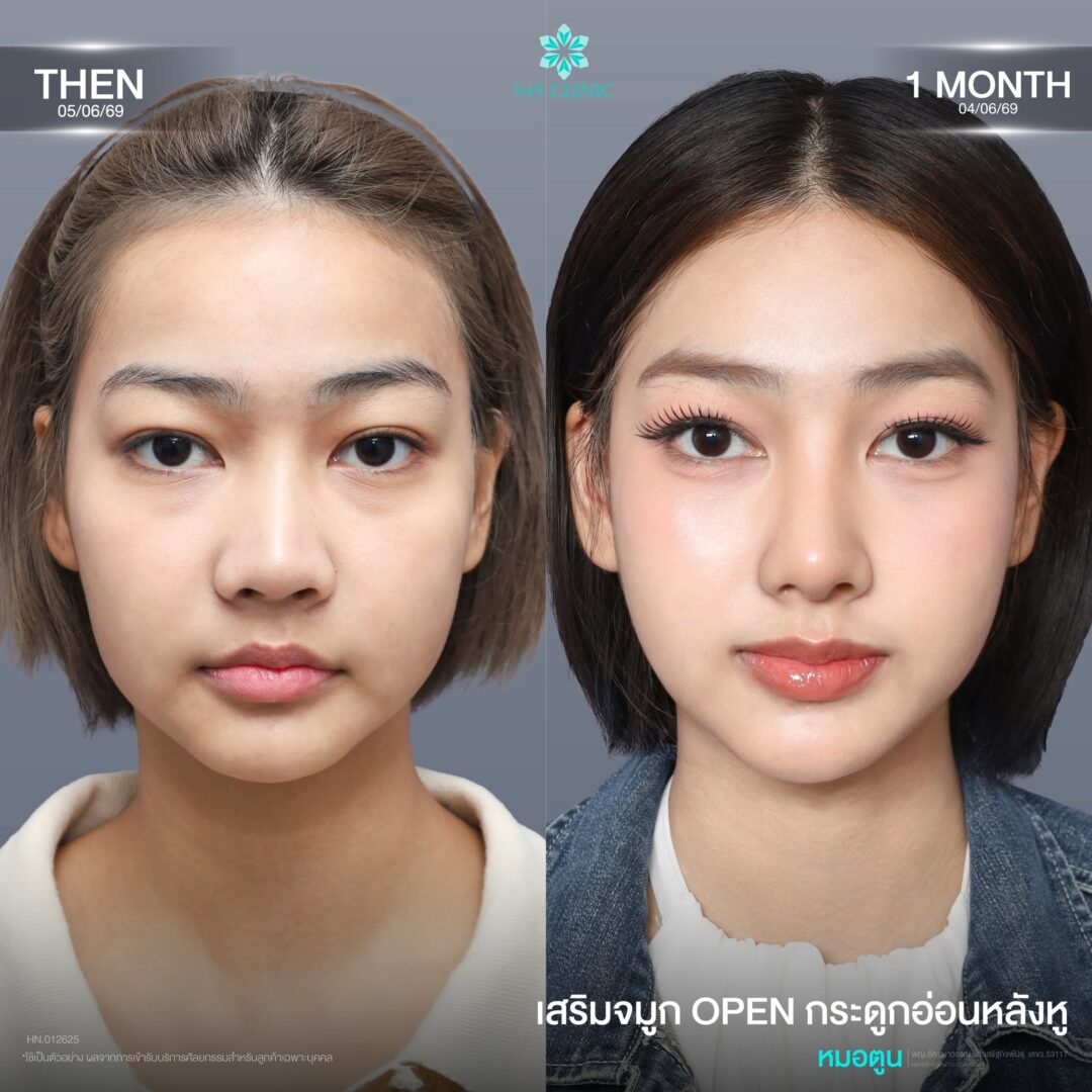 เสริมจมูกกระดูกอ่อนหลังหู