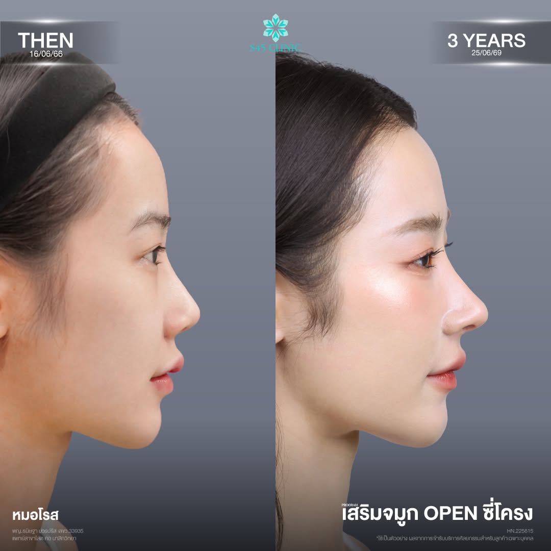 เสริมจมูกซี่โครง