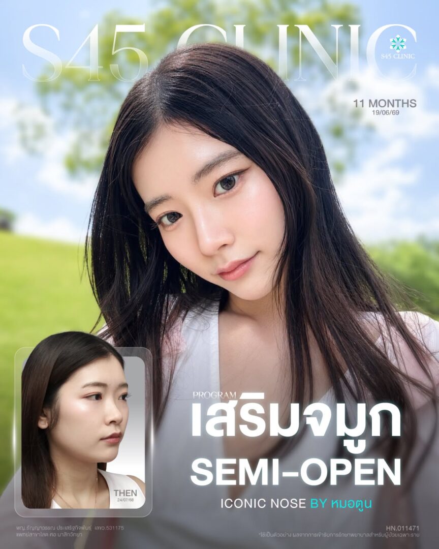เสริมจมูกแท่งแรก