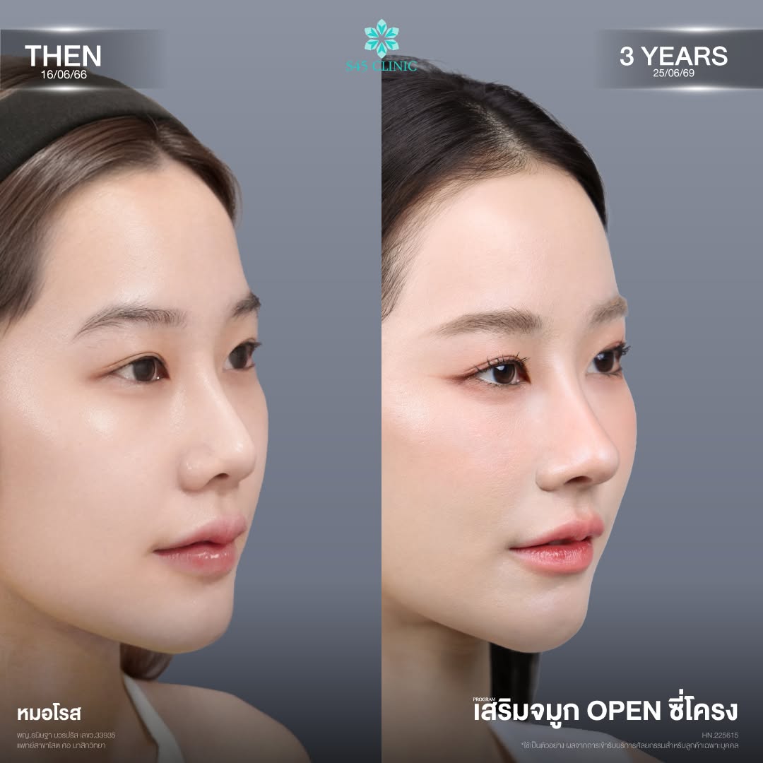 เสริมจมูกโอเพ่นซี่โครง