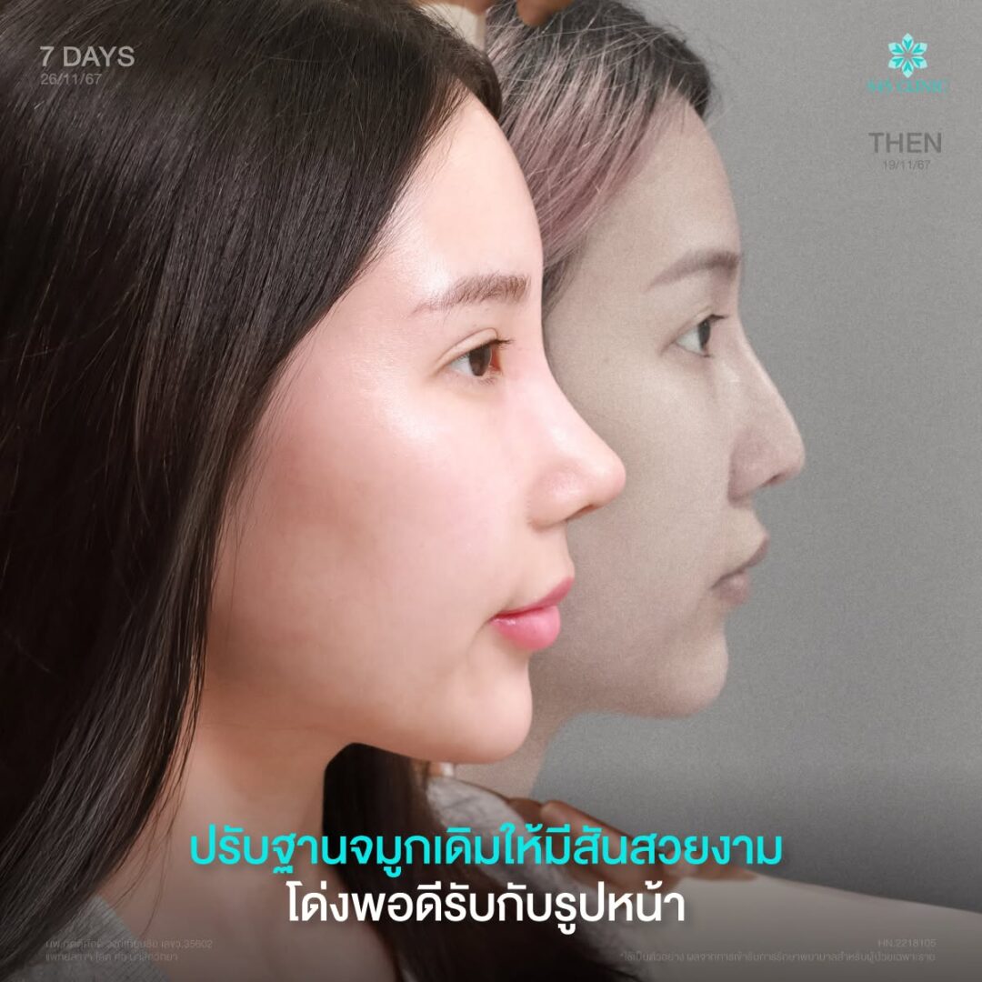 แก้ปลายจมูกงุ้ม