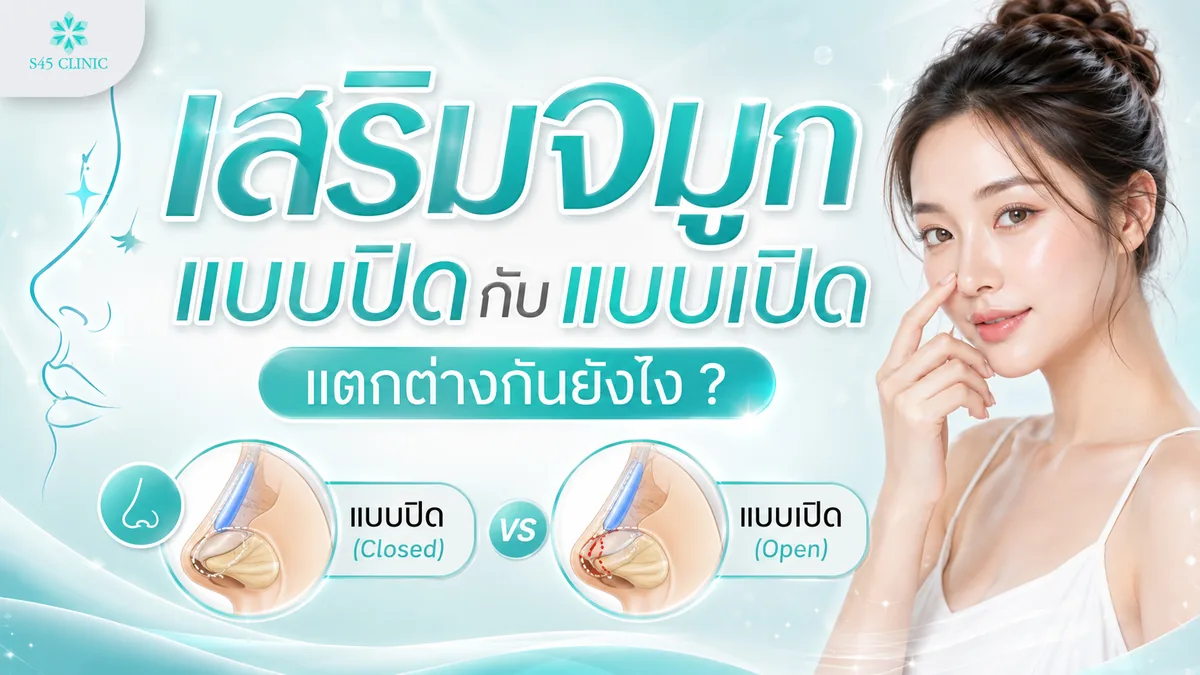 ความต่างระหว่างการเสริมจมูกธรรมชาติแบบปิดกับแบบเปิด