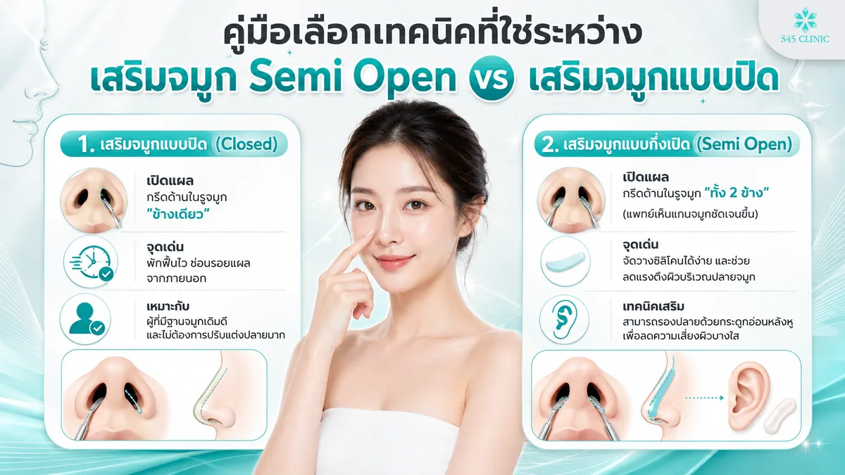 เสริมจมูก Semi Open vs เสริมจมูกแบบปิด ควรเลือกแบบไหน