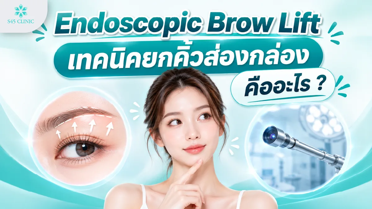 Endoscopic Brow Lift เทคนิคยกคิ้วส่องกล้อง คืออะไร