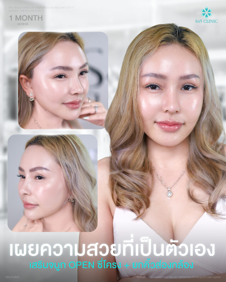ปิงทอง ยกคิ้ว จมูก