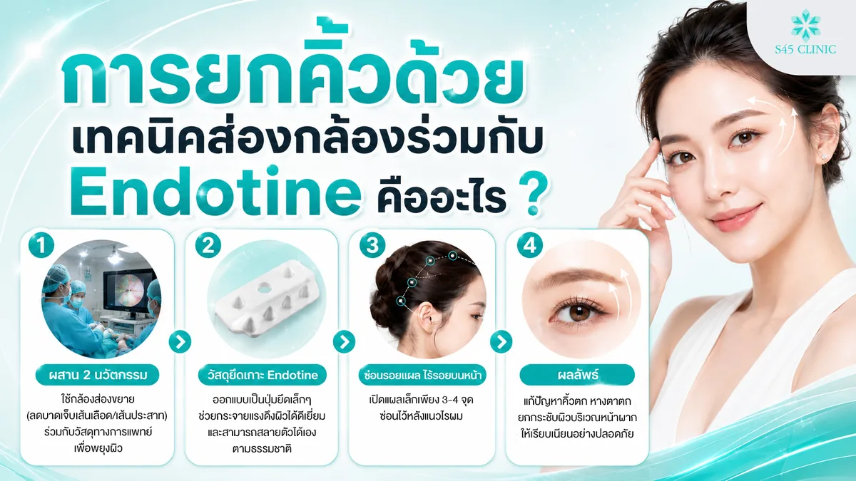 การยกคิ้วด้วยเทคนิคส่องกล้องร่วมกับ Endotine คืออะไร